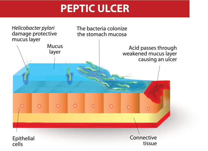 Naturopathic Treatment For Peptic Ulcer